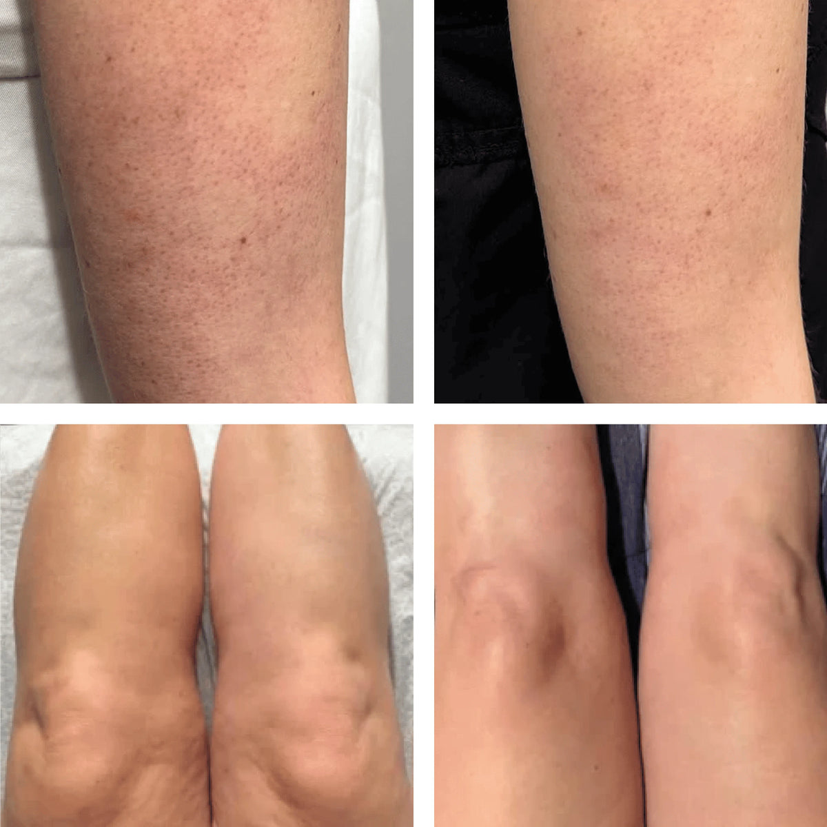 Avant et apres sur les jambes